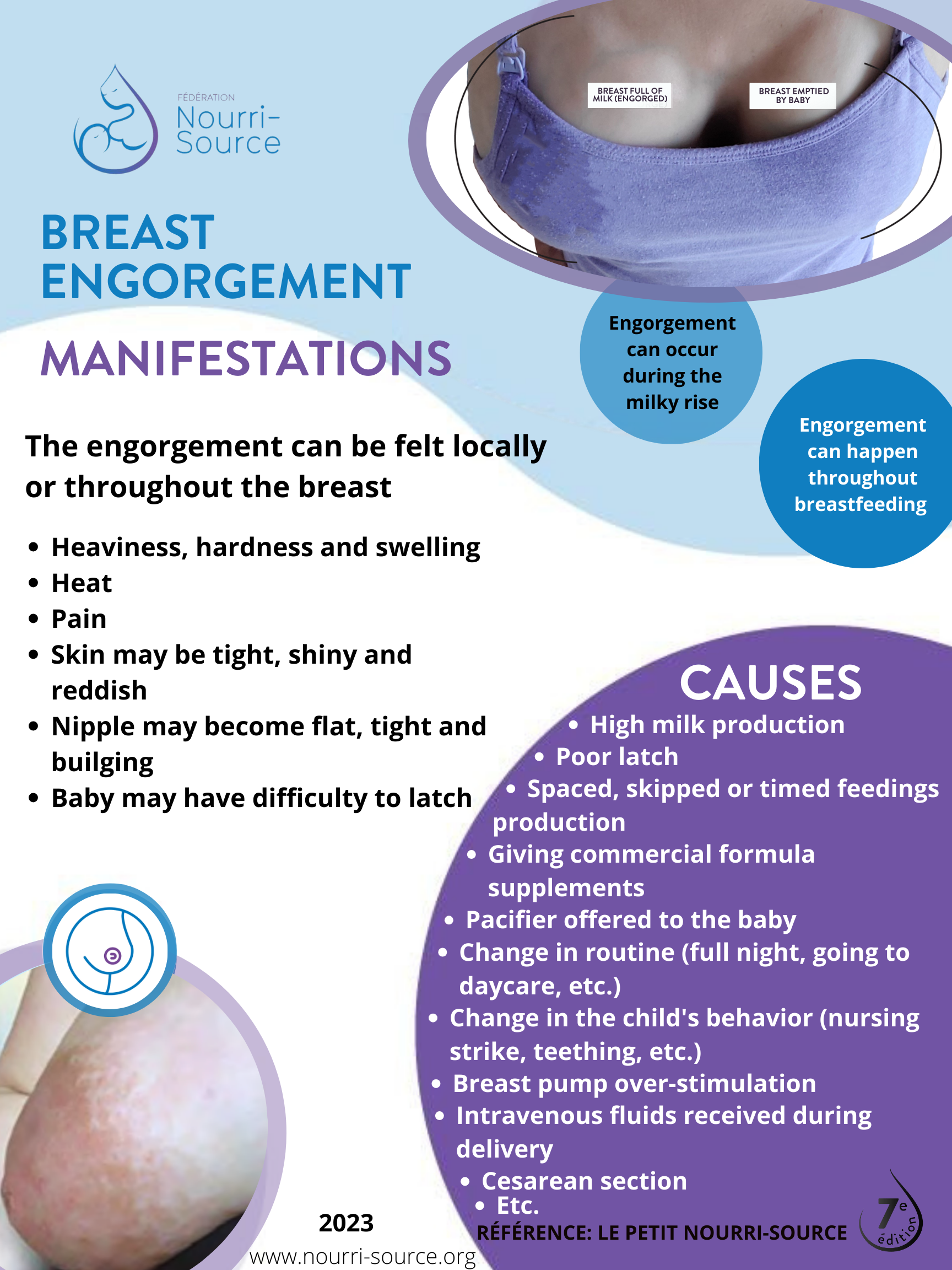 Breast Engorgement Relief — Rejoice Pregnancy